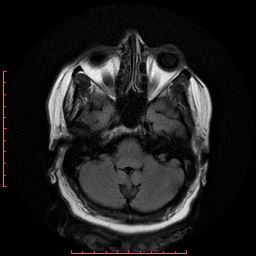 File:Cerebral cavernous malformation (Radiopaedia 26177-26306 FLAIR 6).jpg