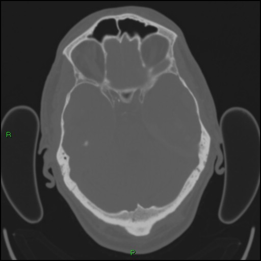 Cerebral contusions (Radiopaedia 33868-35039 Axial bone window 63).jpg