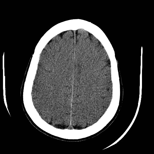 File:Cerebral edema (evolution in time) (Radiopaedia 19418-19440 non-contrast 71).jpg
