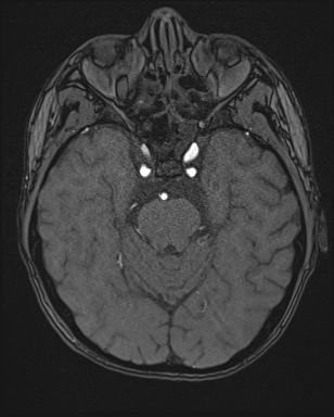 Cerebral embolic infarcts (embolic shower) (Radiopaedia 72391-82921 Axial MRA 47).jpg
