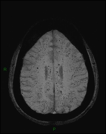 Cerebral fat embolism (Radiopaedia 35022-36525 Axial SWI 39).jpg