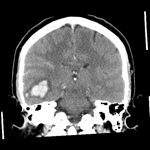 Cerebral hemorrhage secondary to arteriovenous malformation (Radiopaedia 33497-34561 C 39).png