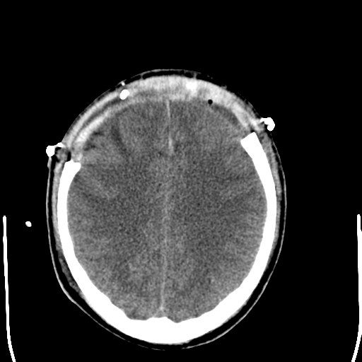 File:Cerebral hemorrhagic contusions- temporal evolution (Radiopaedia 40224-42755 AXIAL THICK 22).png