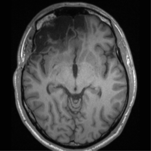 Cerebral hemorrhagic contusions- temporal evolution (Radiopaedia 40224-42757 Axial T1 34).png