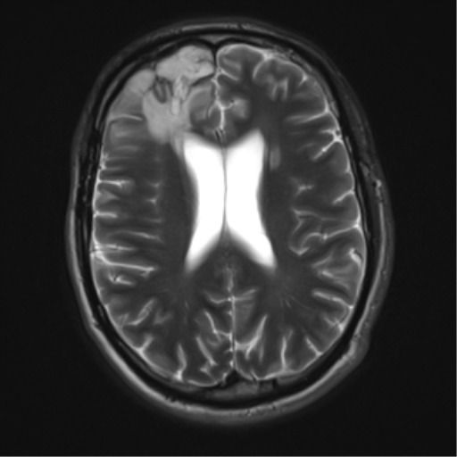 File:Cerebral hemorrhagic contusions- temporal evolution (Radiopaedia 40224-42757 Axial T2 14).png