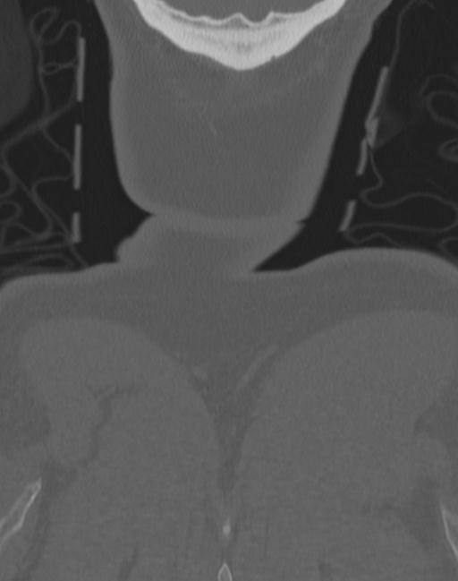 Cerebral hemorrhagic contusions and cervical spine fractures (Radiopaedia 32865-33841 Coronal bone window 85).jpg