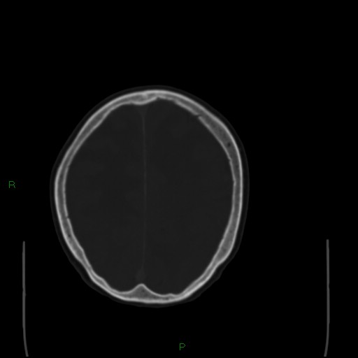 Cerebral metastases - breast primary (Radiopaedia 77653-89857 Axial bone window 87).jpg
