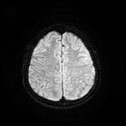 Cerebral metastases - melanoma (Radiopaedia 80972-94522 Axial DWI 22).jpg