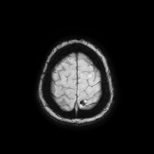 Cerebral metastases - melanoma (Radiopaedia 80972-94522 Axial SWI 89).jpg