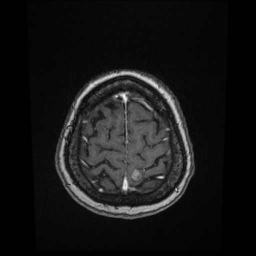 Cerebral metastases - melanoma (Radiopaedia 80972-94522 Axial T1 C+ 81).jpg