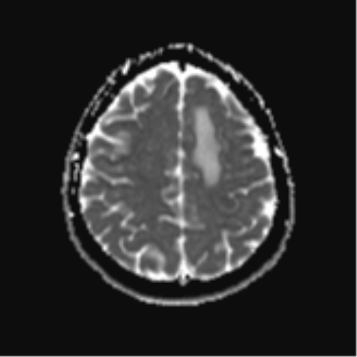 File:Cerebral metastases mimicking abscesses (Radiopaedia 45841-50131 Axial ADC 22).png