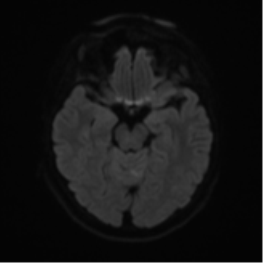 File:Cerebral metastases mimicking abscesses (Radiopaedia 45841-50131 Axial DWI 40).png