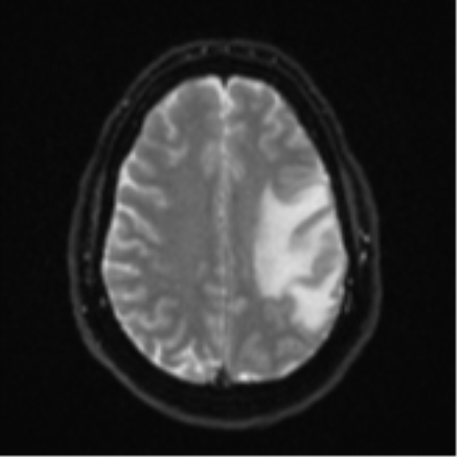 Cerebral metastases mimicking multifocal glioblastoma (Radiopaedia 50843-56353 Axial DWI 19).png