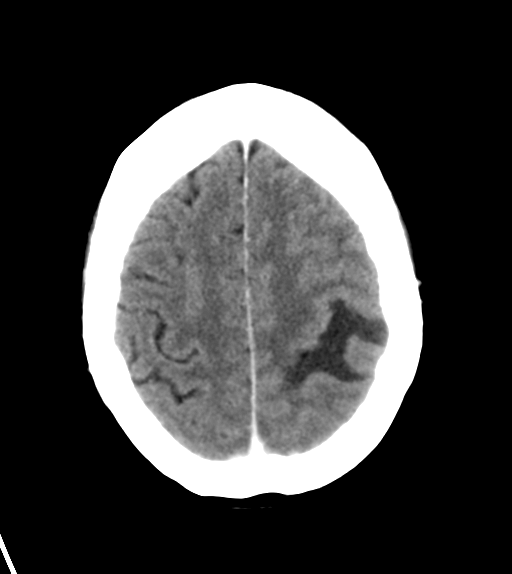 File:Cerebral metastasis (Radiopaedia 46744-51260 Axial C+ delayed 24).png