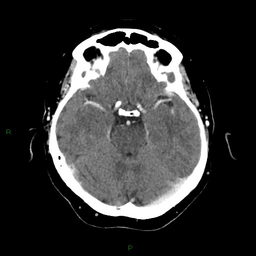 File:Cerebral metastasis from renal cell carcinoma (Radiopaedia 82306-96375 Axial C+ delayed 13).jpg