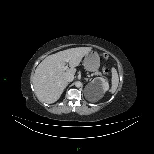 Cerebral metastasis from renal cell carcinoma (Radiopaedia 82306-96378 A 46).jpg