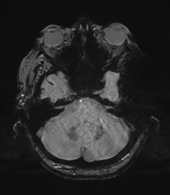 Cerebral metastasis to basal ganglia (Radiopaedia 81568-95413 Axial SWI magnitude 18).png