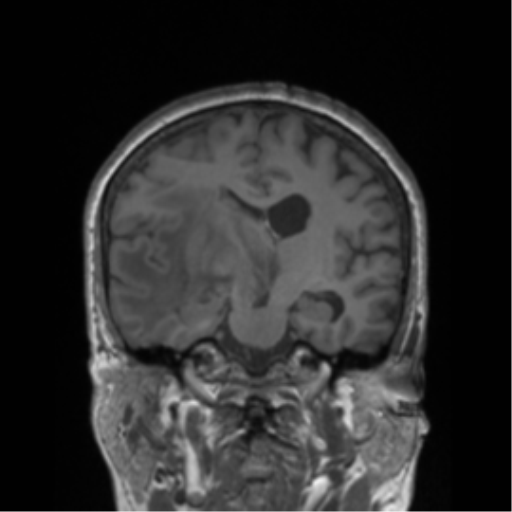 Cerebral metastasis to basal ganglia (Radiopaedia 81568-95413 Coronal T1 25).png