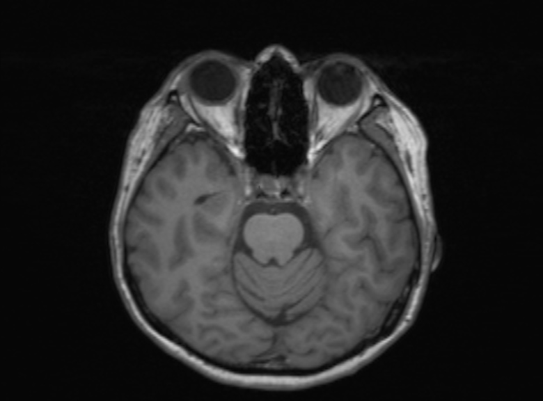 Cerebral ring enhancing lesions - cerebral metastases (Radiopaedia 44922-48817 Axial T1 273).jpg