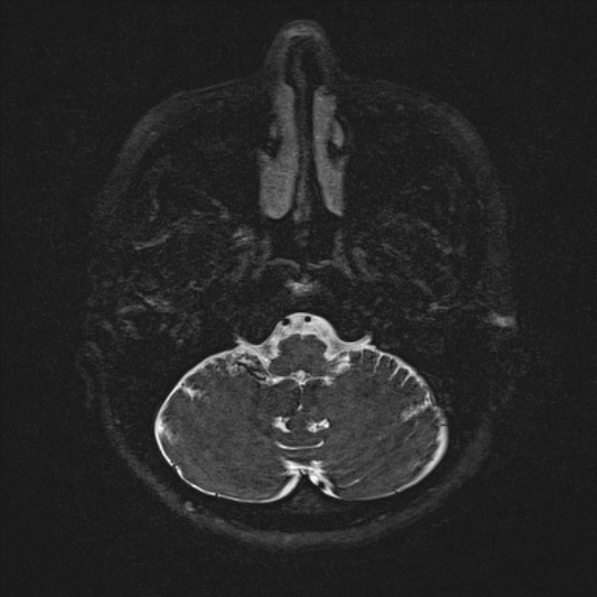 Cerebral ring enhancing lesions - cerebral metastases (Radiopaedia 44922-48817 F 10).jpg