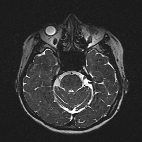 Cerebral ring enhancing lesions - cerebral metastases (Radiopaedia 44922-48817 F 52).jpg