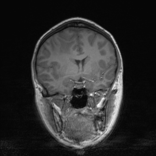 Cerebral tuberculosis with dural sinus invasion (Radiopaedia 60353-68090 Coronal T1 82).jpg