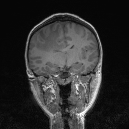 Cerebral tuberculosis with dural sinus invasion (Radiopaedia 60353-68090 Coronal T1 97).jpg