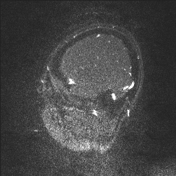 Cerebral tuberculosis with dural sinus invasion (Radiopaedia 60353-68090 Sagittal MRV 134).jpg