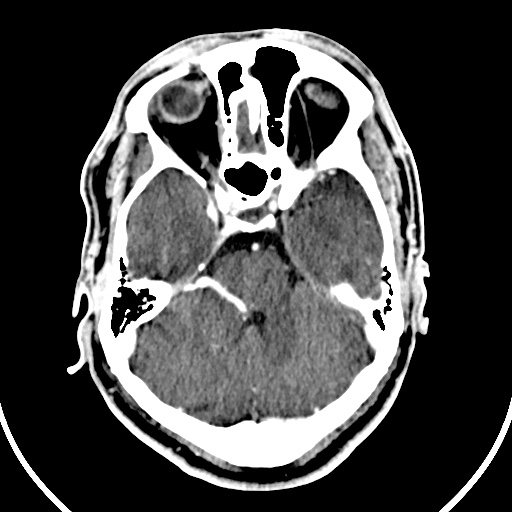 File:Cerebral venous angioma (Radiopaedia 69959-79977 B 18).jpg