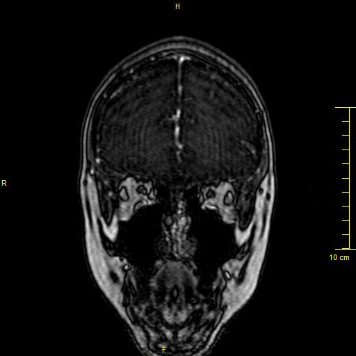 Cerebral venous thrombosis (Radiopaedia 23288-23351 MRV 13).JPG