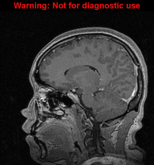 Cerebral venous thrombosis (Radiopaedia 37224-39208 Sagittal T1 C+ 88).jpg