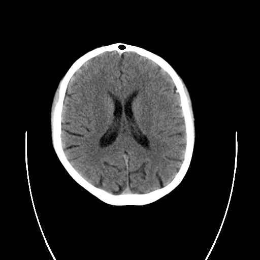 File:Cerebral venous thrombosis (Radiopaedia 38392-40467 Coronal non-contrast 1).png