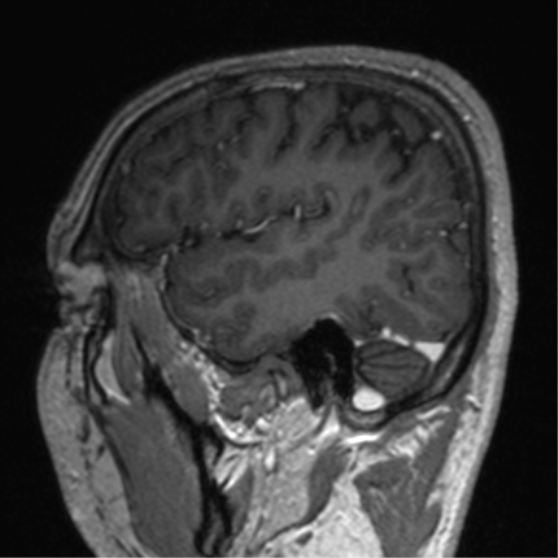 Cerebral venous thrombosis (Radiopaedia 38392-40469 Sagittal T1 C+ 69).png