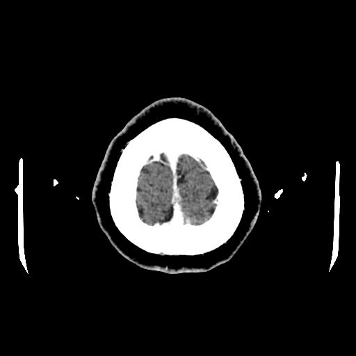 File:Cerebral venous thrombosis with venous hemorrhagic infarct (Radiopaedia 90354-107660 Axial with contrast 159).jpg