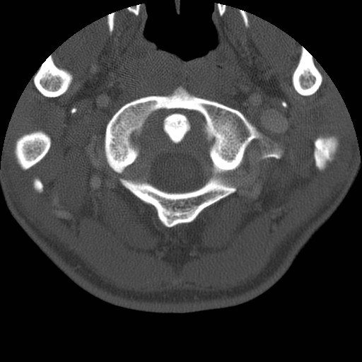 Cervical Pott disease (Radiopaedia 20374-20286 Axial bone window 19).jpg