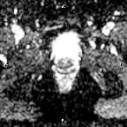 File:Cervical adenocarcinoma (Radiopaedia 65011-73985 Axial ADC 8).jpg