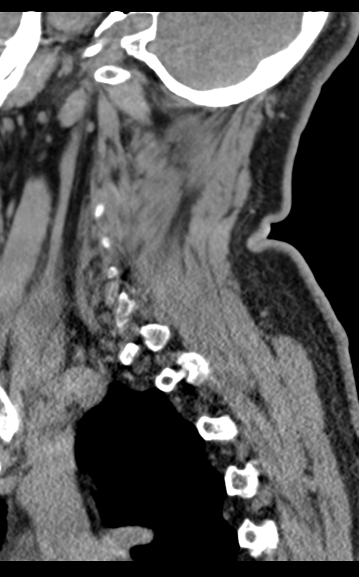 Cervical canal stenosis due to ossification of the posterior longitudinal ligament (Radiopaedia 47260-51823 D 63).png