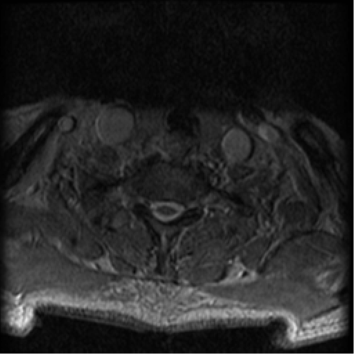 Cervical canal stenosis with cord compression (Radiopaedia 34114-35374 Axial Gradient Echo 13).png