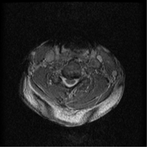 Cervical canal stenosis with cord compression (Radiopaedia 34114-35374 Axial Gradient Echo 43).png