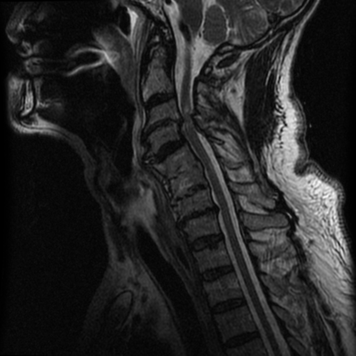 File:Cervical canal stenosis with cord compression (Radiopaedia 34114-35374 Sagittal T2 7).png