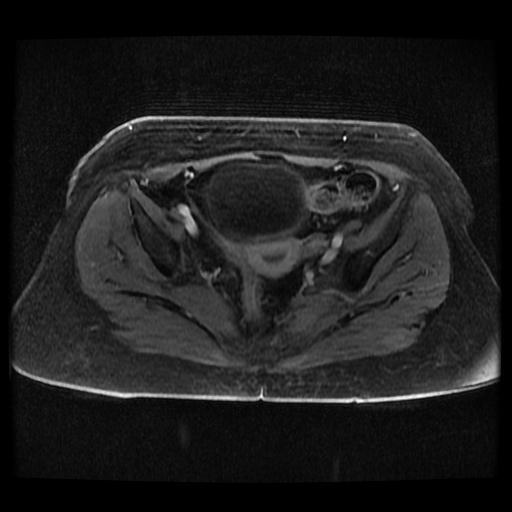 Cervical carcinoma (Radiopaedia 70924-81132 Axial T1 C+ fat sat 234).jpg