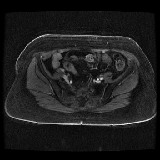 Cervical carcinoma (Radiopaedia 70924-81132 Axial T1 C+ fat sat 69).jpg