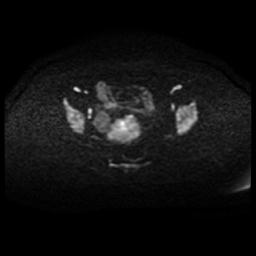 Cervical carcinoma (Radiopaedia 88010-104555 Axial DWI 71).jpg