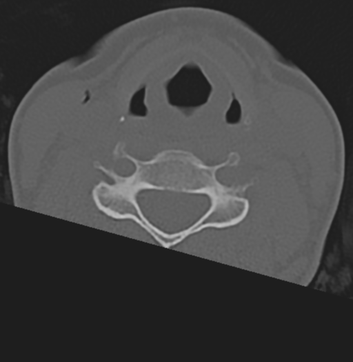 File:Cervical disc replacement (Radiopaedia 37383-39205 Axial bone window 2).png