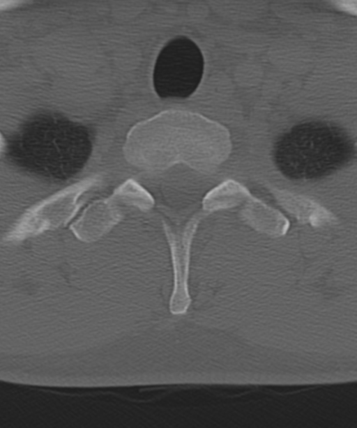 Cervical intercalary bone (Radiopaedia 35211-36748 Axial bone window 61).png