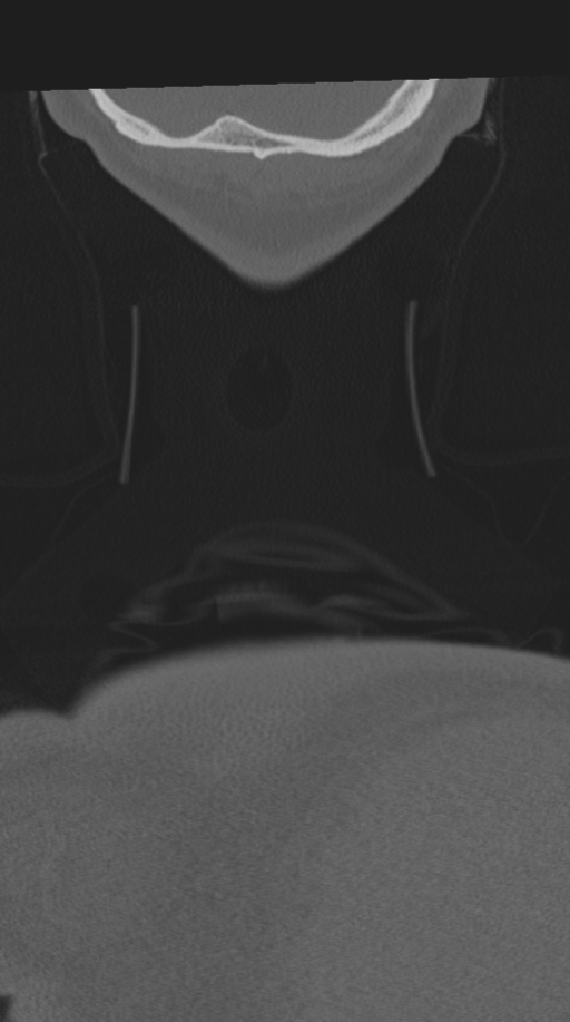 Cervical intercalary bone (Radiopaedia 35211-36748 Coronal bone window 89).png