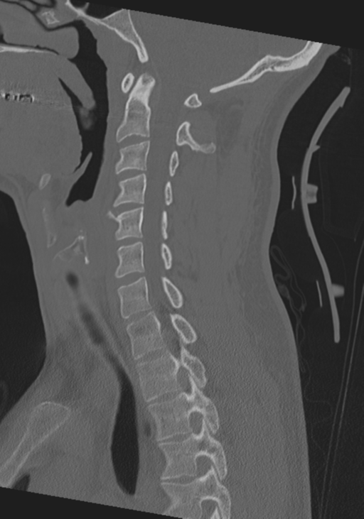 Cervical intercalary bone (Radiopaedia 35211-36748 Sagittal bone window 45).png