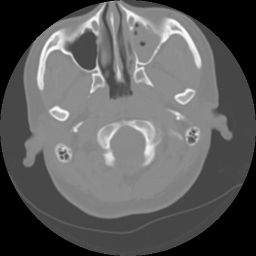 Cervical rib (Radiopaedia 71110-81363 Axial non-contrast 13).jpg