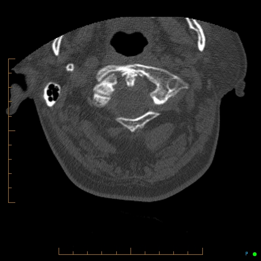 Cervical spine fracture - ankylosing spondylitis (Radiopaedia 76835-88706 Axial bone window 22).jpg