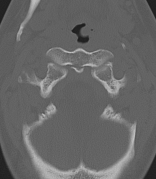 File:Cervical spine fractures with vertebral artery dissection (Radiopaedia 53296-59268 Axial bone window 14).png